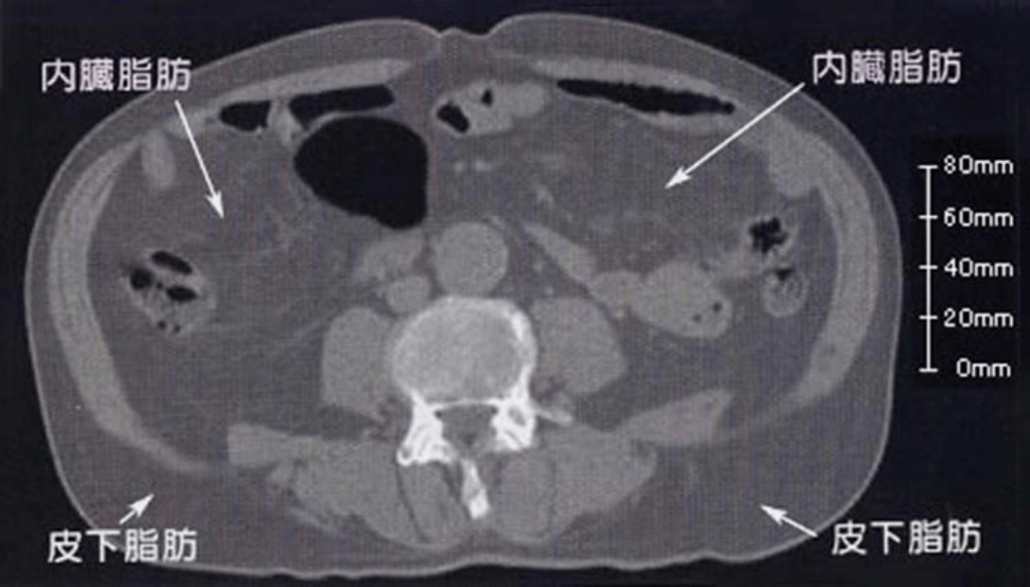 CTスキャンによる内臓肥満の測定の際の写真